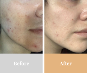 before and after treatment with Omnilux products